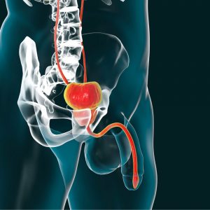 Ilustração anatômica da estenose de uretra — bexiga, próstata e canal uretral
